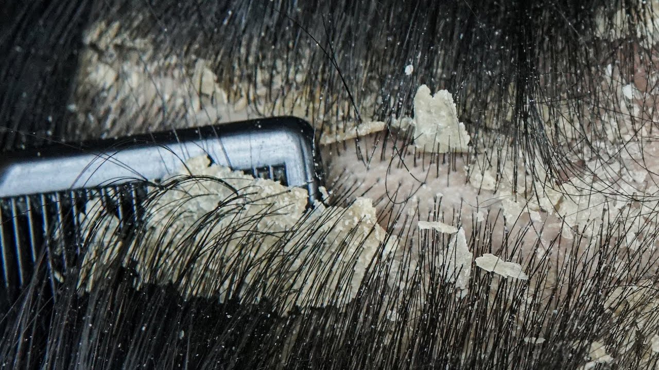 Satisfying Scalp Dandruff Removal: Comb Scratching #DKMO3074