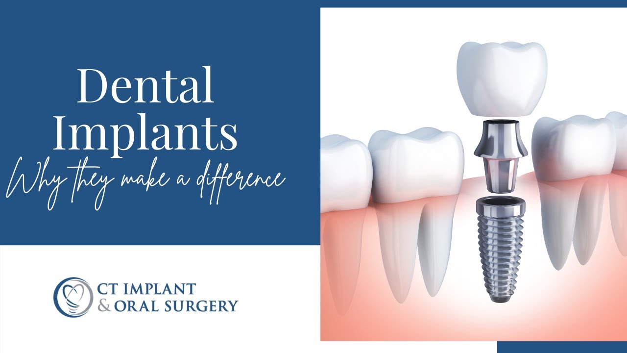 Important Reasons to Replace Your Missing Teeth With Implants