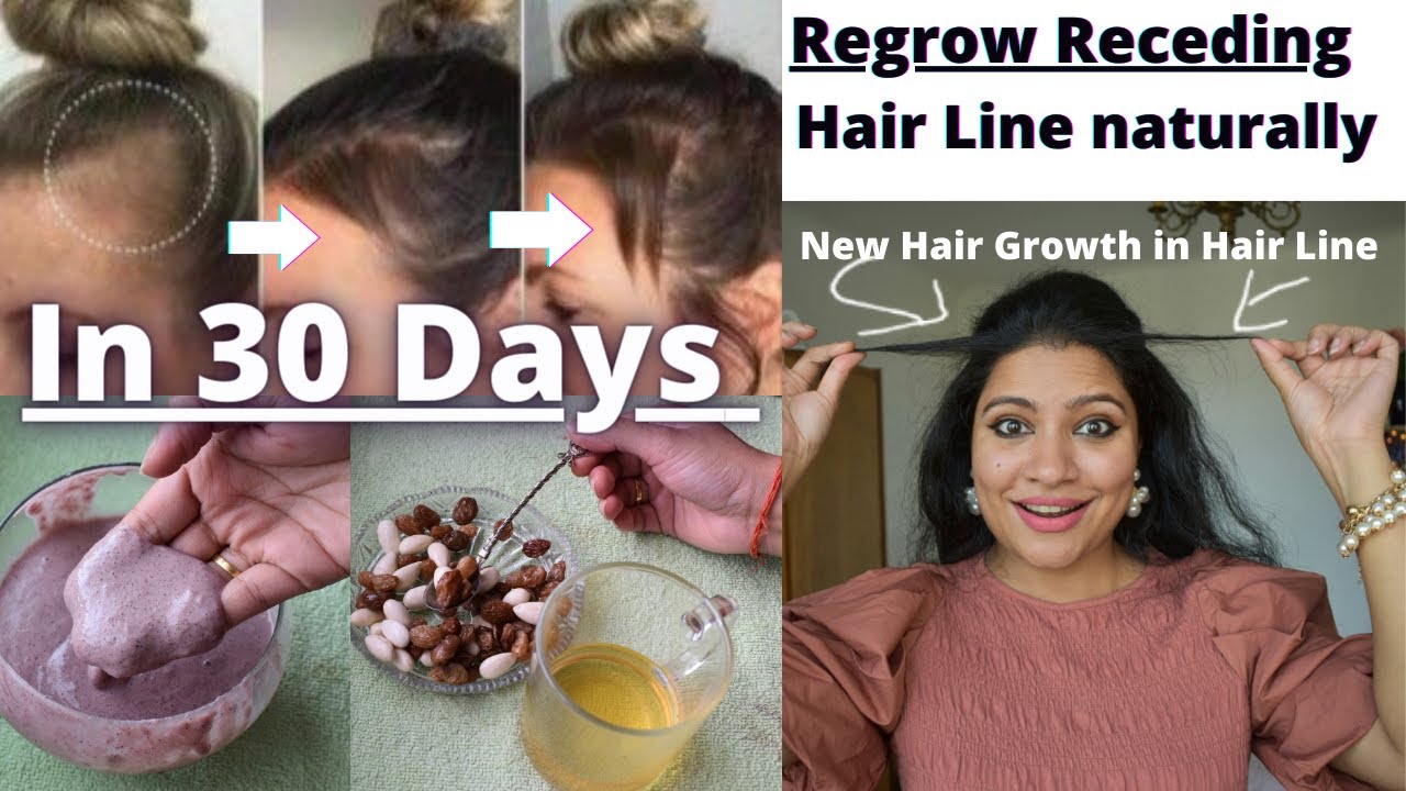 Regrow Receding HairLine in Just 30 Days With This Hair Mask & Healthy Diet/Regrow Receding Hairline
