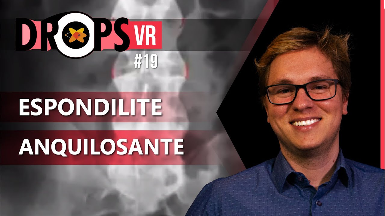 ESPONDILITE ANQUILOSANTE