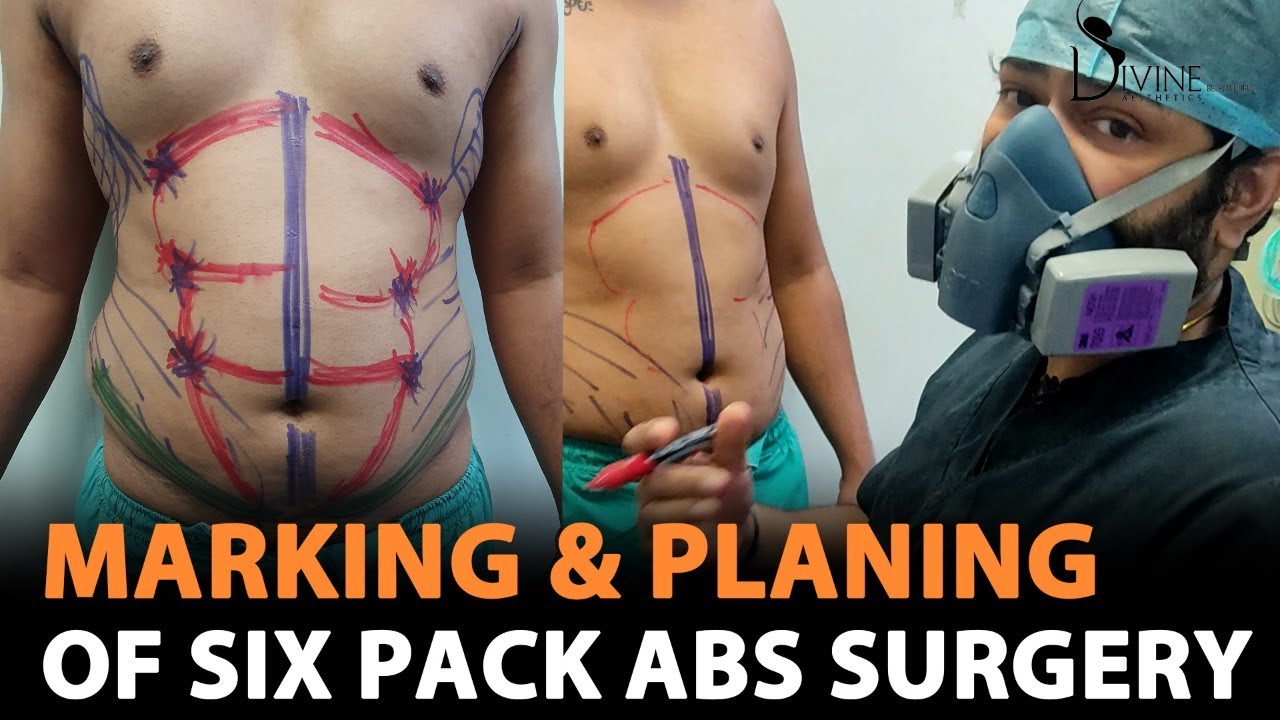 Six Pack Abs Surgery Marking | 6 Pack Abs Marking | Plastic Surgery in India