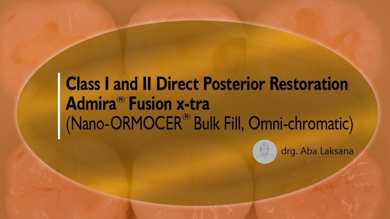 Admira&reg; Fusion X-tra on Direct Composite Restoration Class I - II (Bulk Fill Technique) ORMOCER VOCO