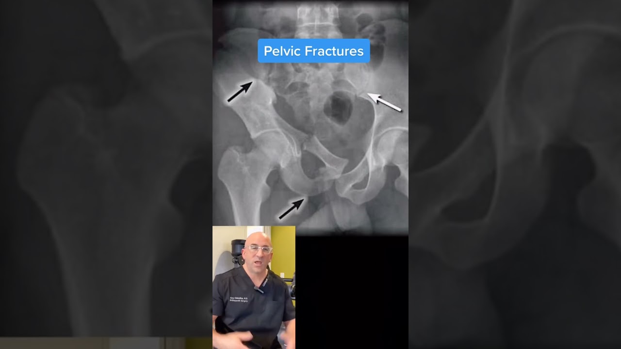 Toughest Surgery #orthopedicsurgery #fractures #trauma #nashville