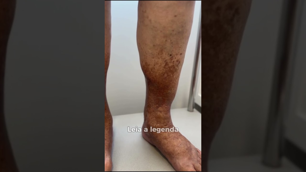 Você sabia que as varizes podem mudar a coloração da pele?