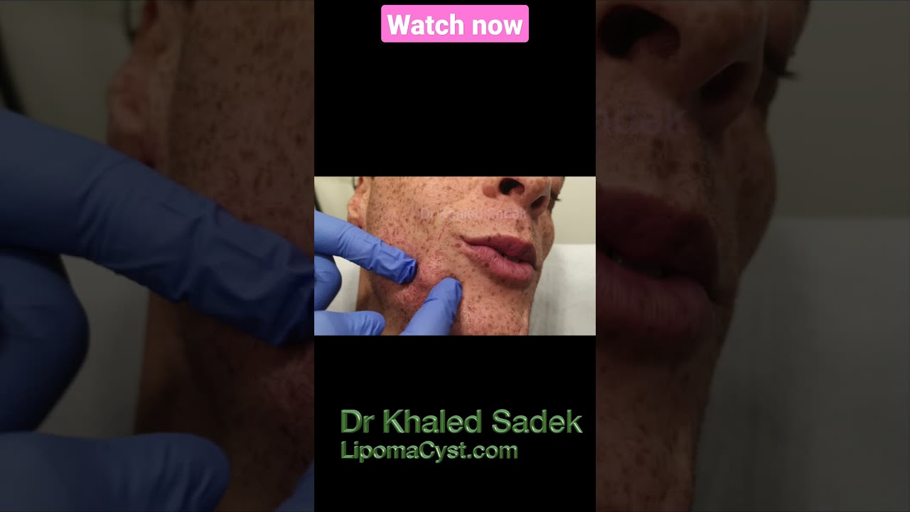 face cyst #shorts #blackheads dr khaled sadek