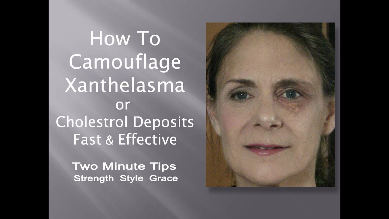 Xanthelasma or Cholesterol Deposits and How to Camouflage Easily & Effectively for Great Makeup .