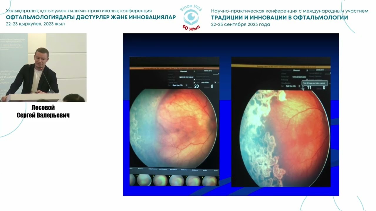 Результаты применения анти VEGF терапии у детей в активной фазе ретинопатии недоношенных