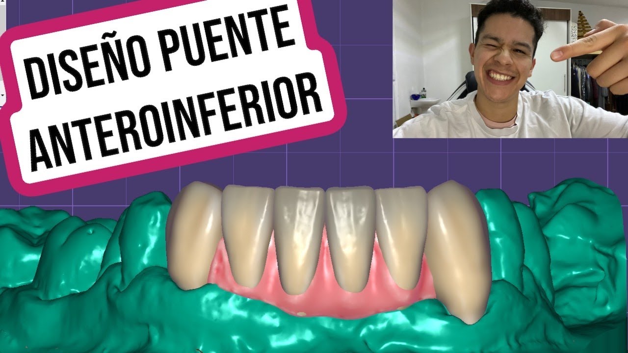 DISEÑO PUENTE INFERIOR EN EXOCAD (paso a paso)/LOWER BRIDGE DESIGN IN EXOCAD (step by step)