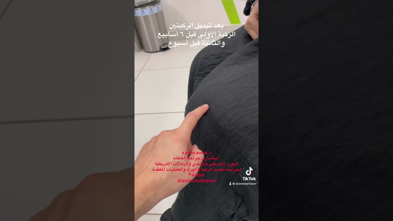 نتائج تبديل مفصل الركبتين. . عمليات اليوم الواحد لتبديل مفصل الركبة مع د.عاصم مخدوم