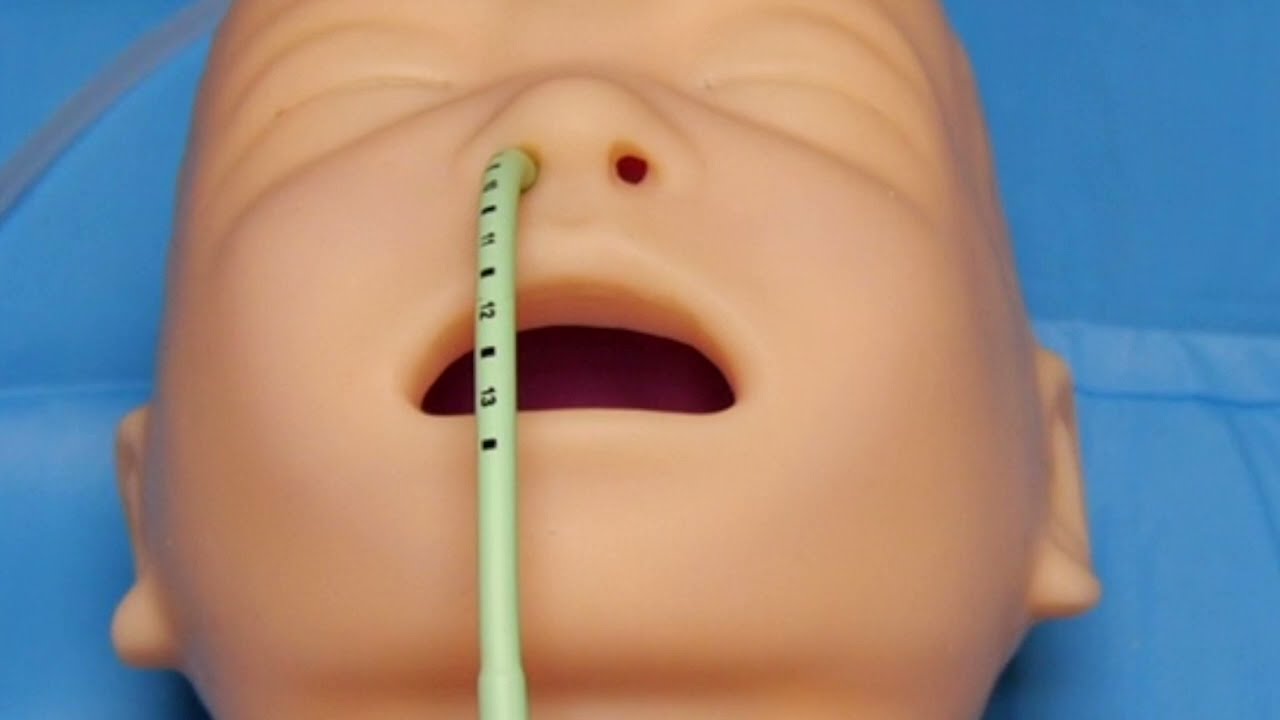 Réanimation du nouveau-né en salle de naissance : D1 Intubation naso thrachéale