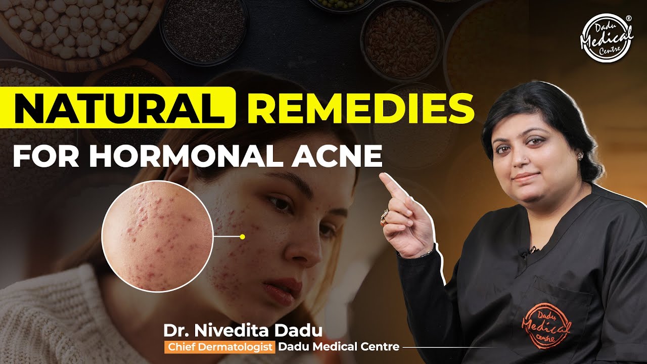 Natural Treatment for Hormonal Acne by Dermatologist | Acne Treatment In Delhi | Dr. Nivedita Dadu