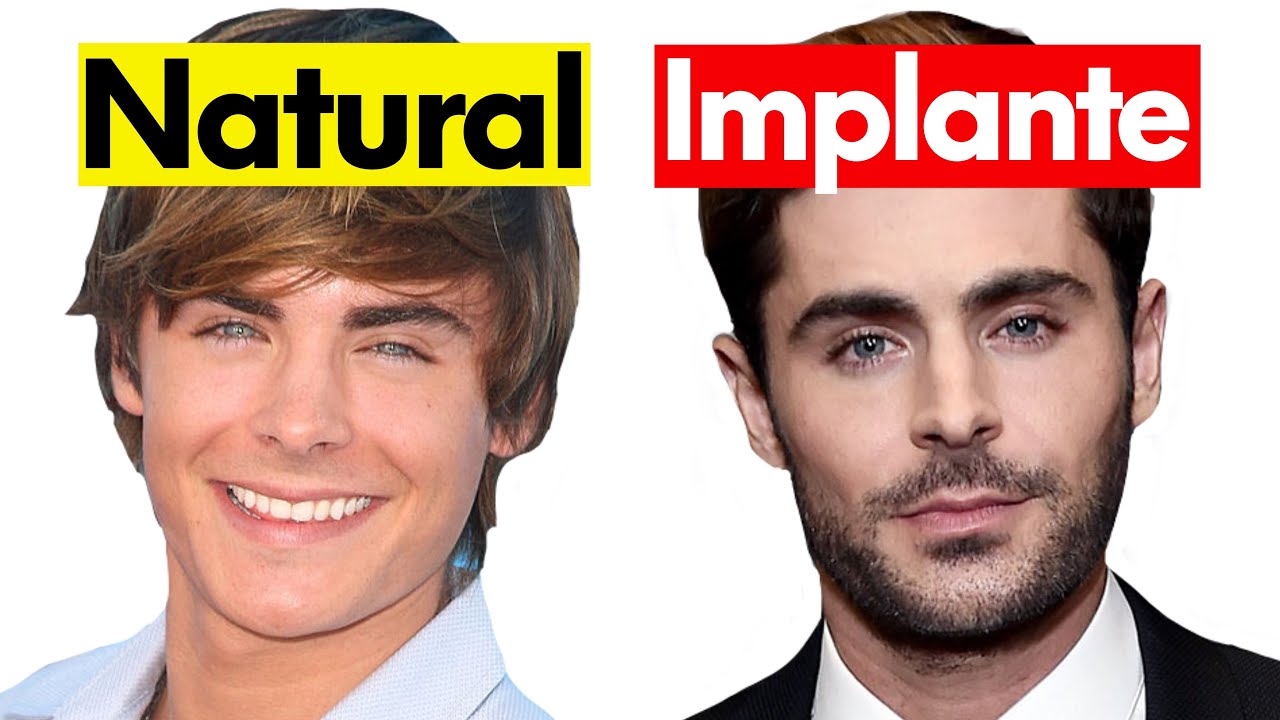 La Barba de Zac Efron es Implantada o Natural