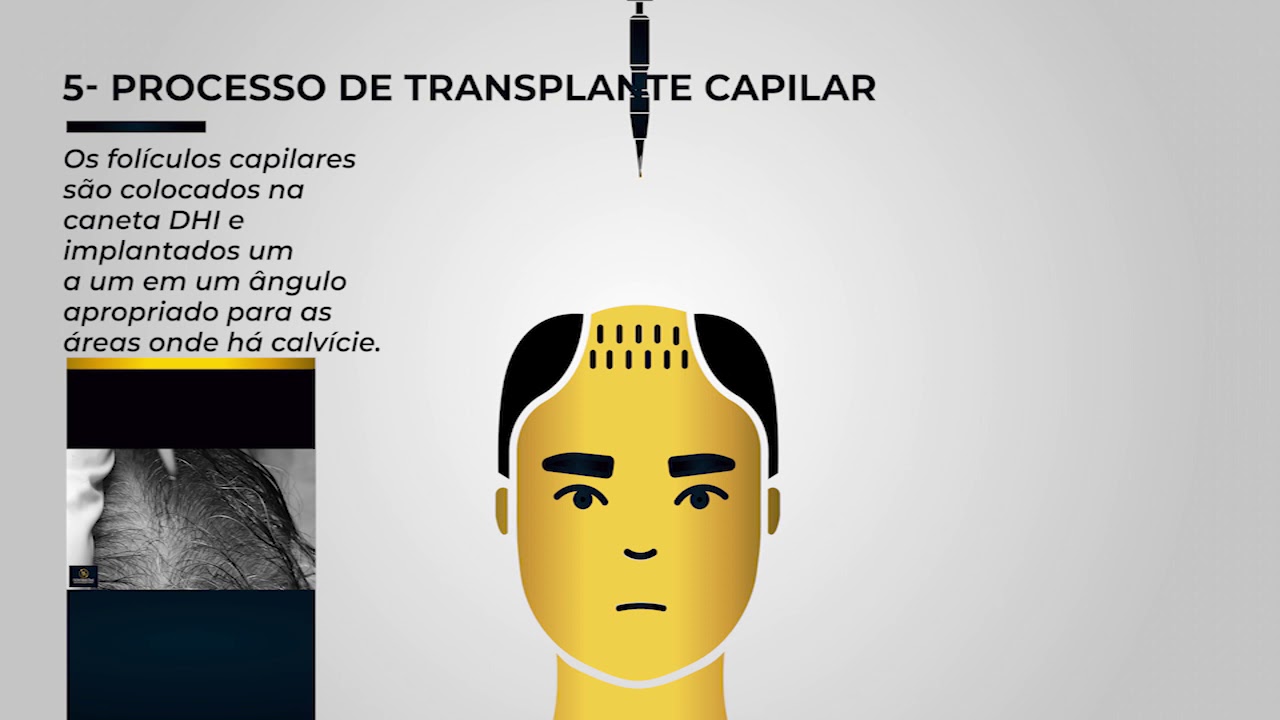 Transplante Capilar DHI