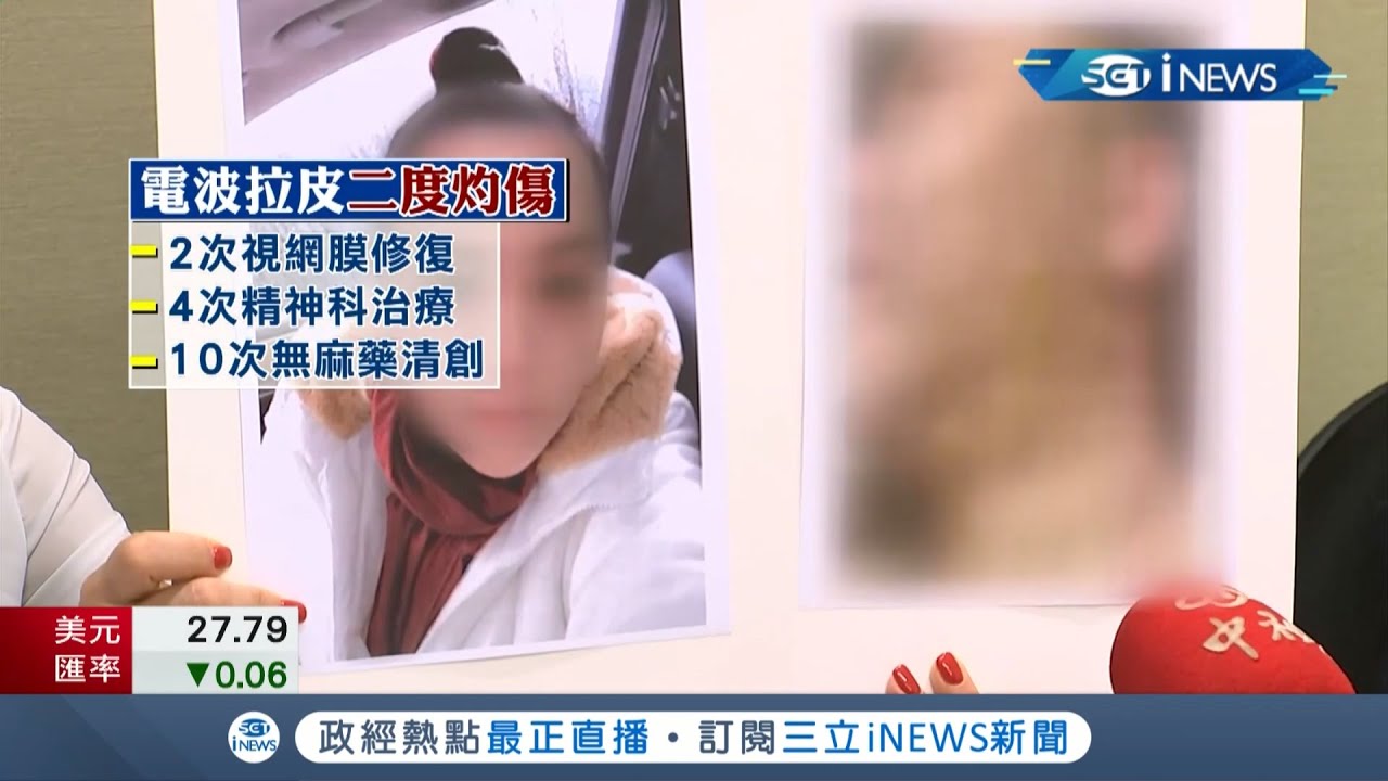 臉可是女人的第二生命... 美魔女做電波拉皮卻二度灼傷毀容成