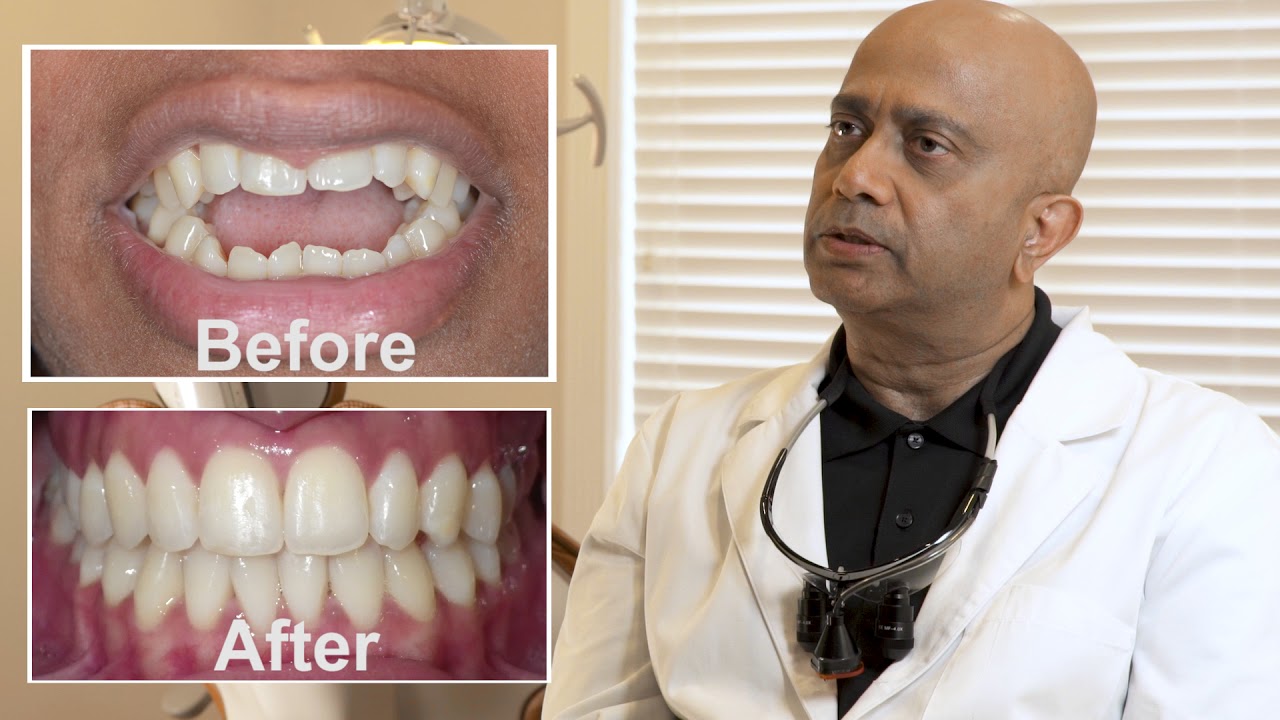 Fastbraces&reg; Vs Traditional Braces - West Hartford, CT - Dr. Abraham K. John