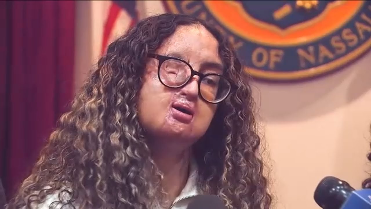 Still no arrest after Hofstra student attacked with acid in 2021