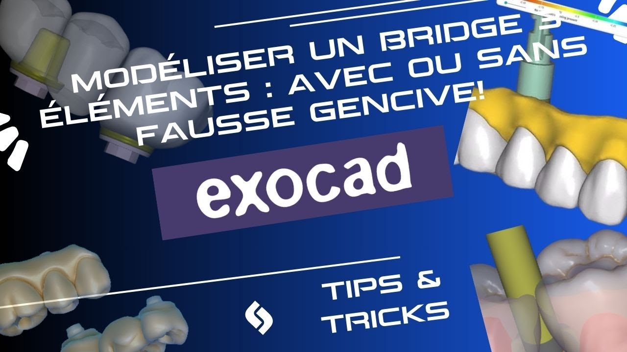 Exocad : Modélisez un bridge 3 éléments avec un workflow simple (avec ou sans fausse gencive)!