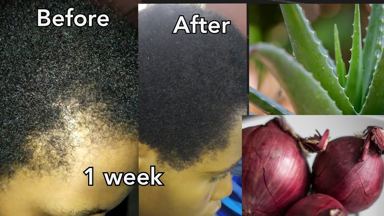 How I REGREW My Edges With ALOE VERA and ONIONS | Natural EDGE CONTROL And FAST HAIR GROWTH