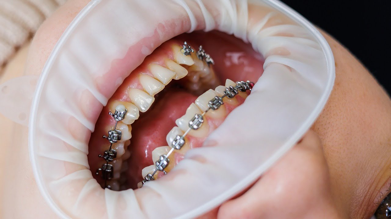 &iquest;C&Oacute;MO SE PONEN LOS BRACKETS? &iexcl;INSTALACION DE ORTODONCIA EN VIVO!