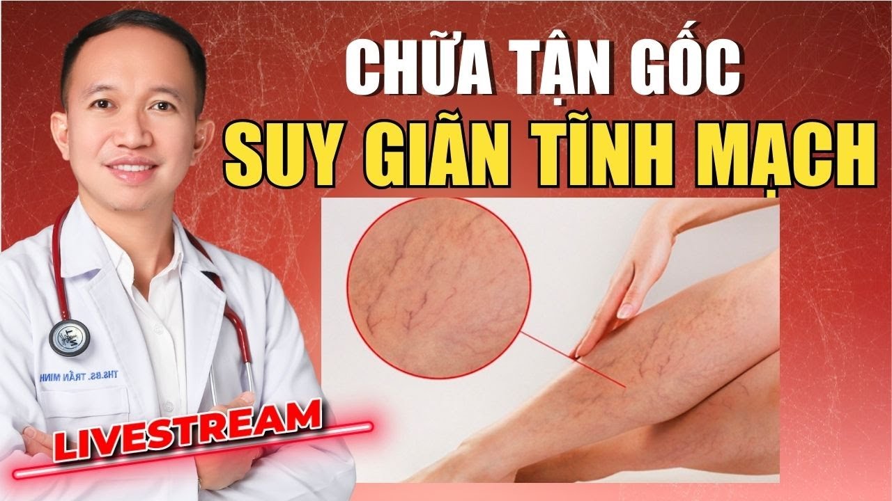 CHỮA TẬN GỐC SUY GIÃN TĨNH MẠCH CHÂN CÙNG VỚI BÁC SĨ TĨNH MẠCH