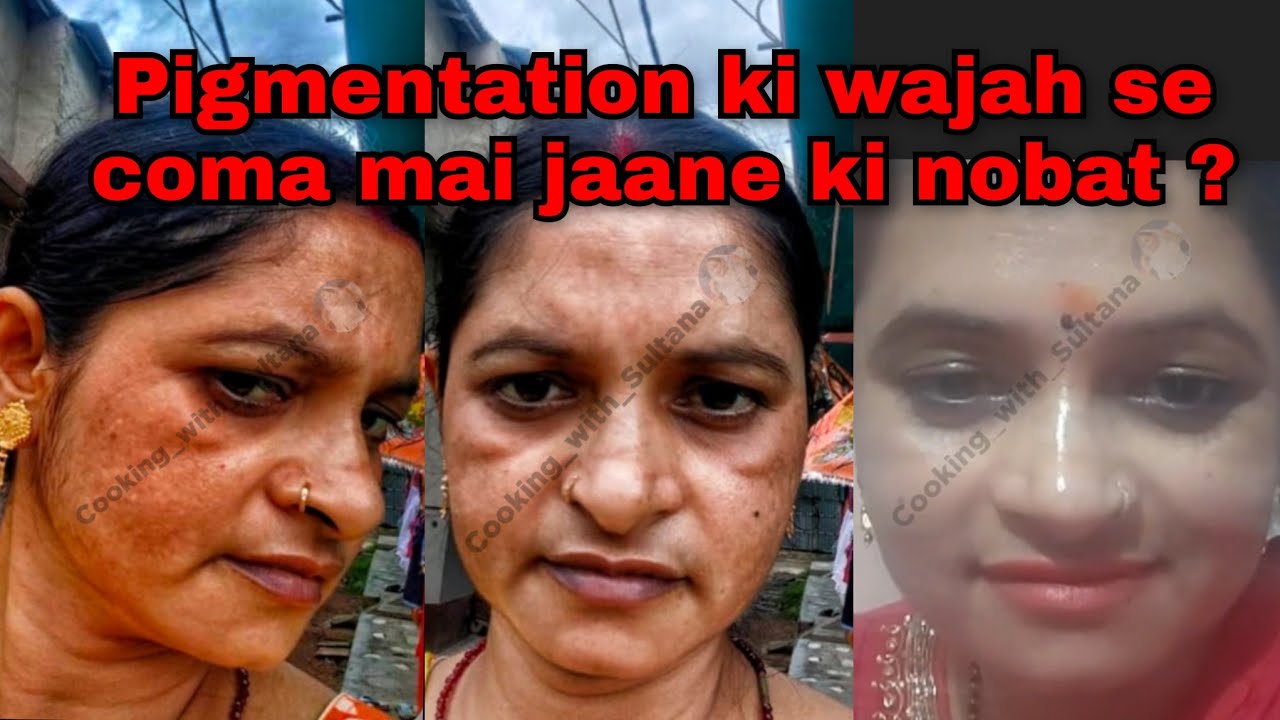 Pigmentation Khatam | Pigmentation Removing Bumper Remedy | Cooking with Sultana 
