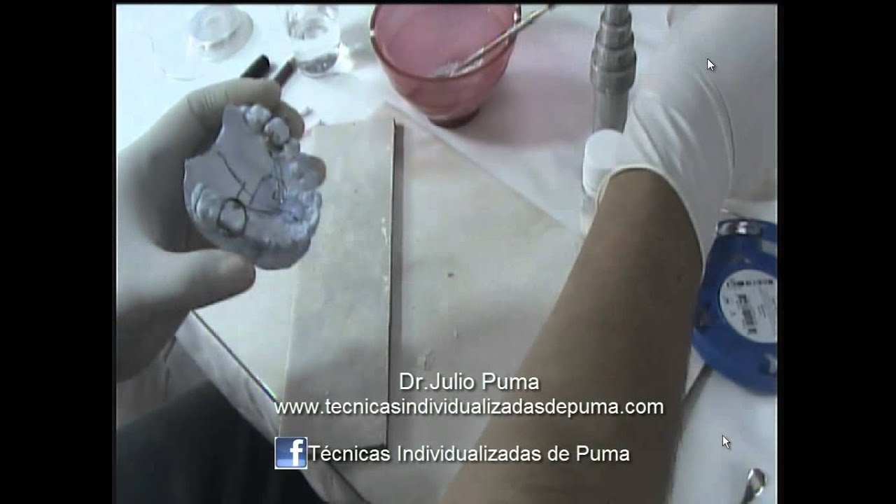 Curso de Ortodoncia, Boton de Nance ,