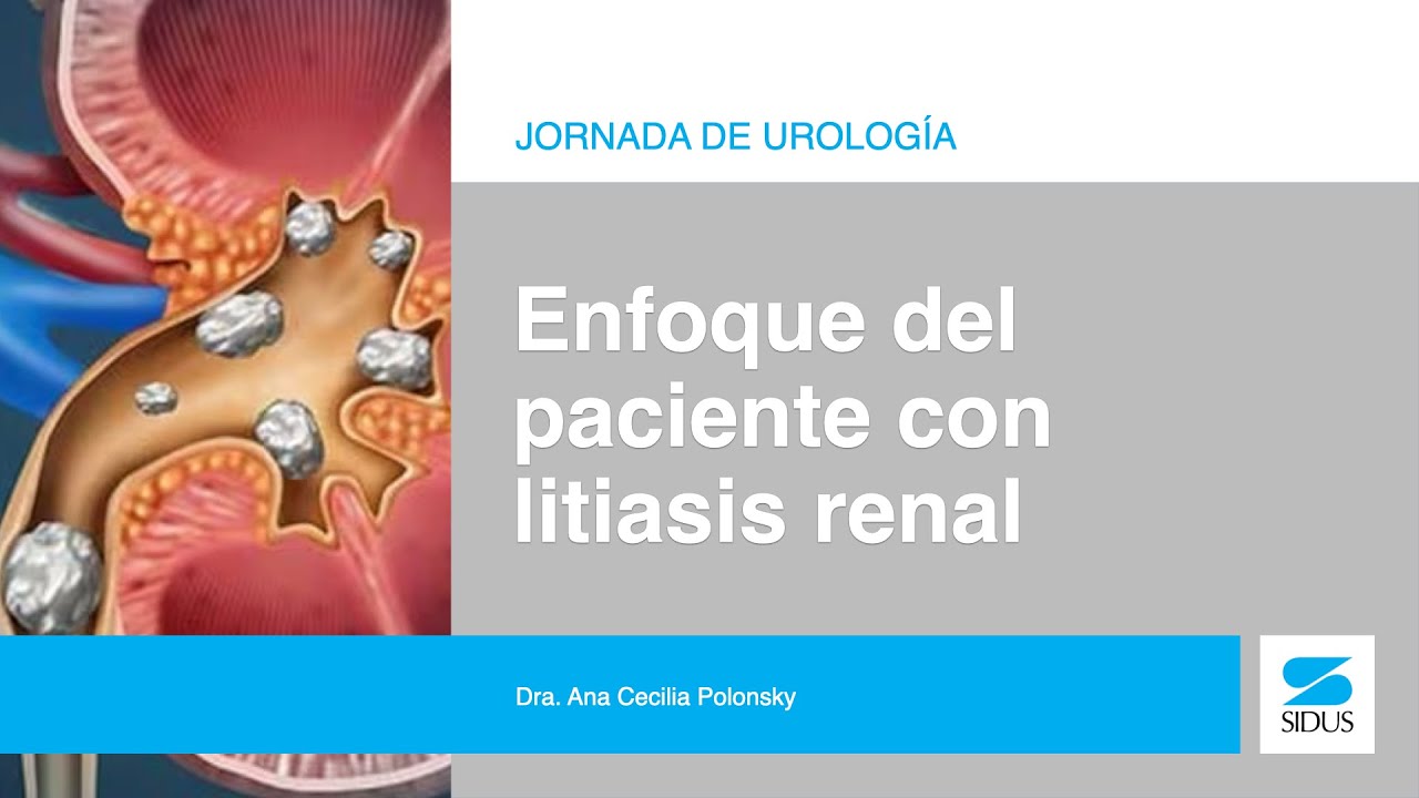 Enfoque del paciente con litiasis renal