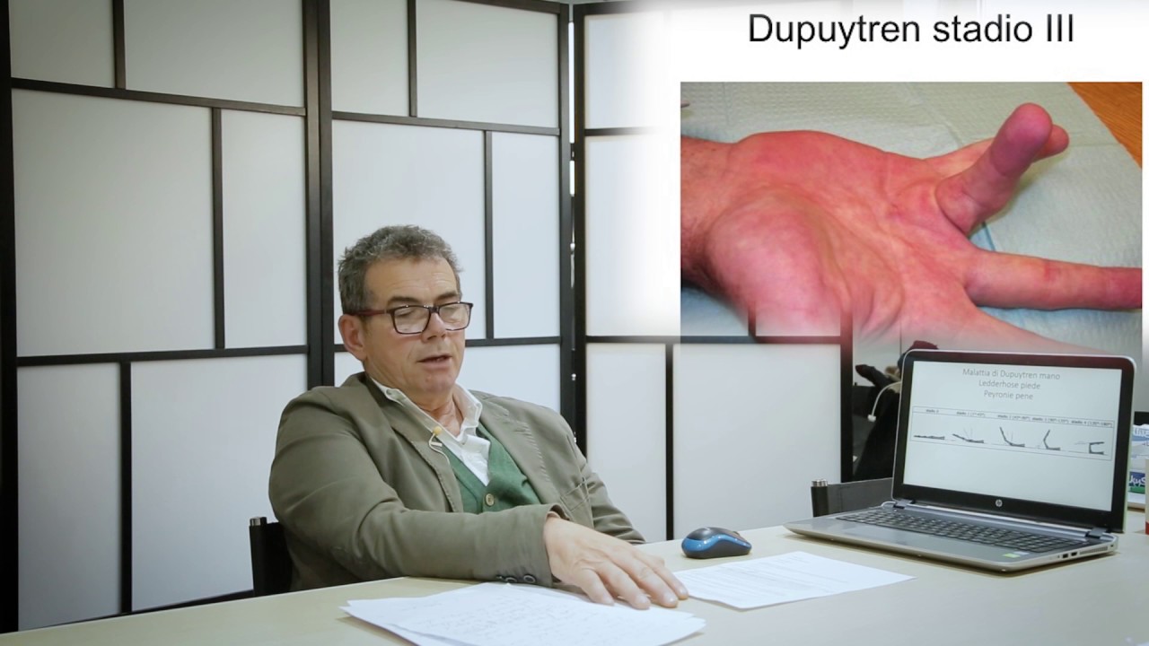 La malattia di Dupuytren