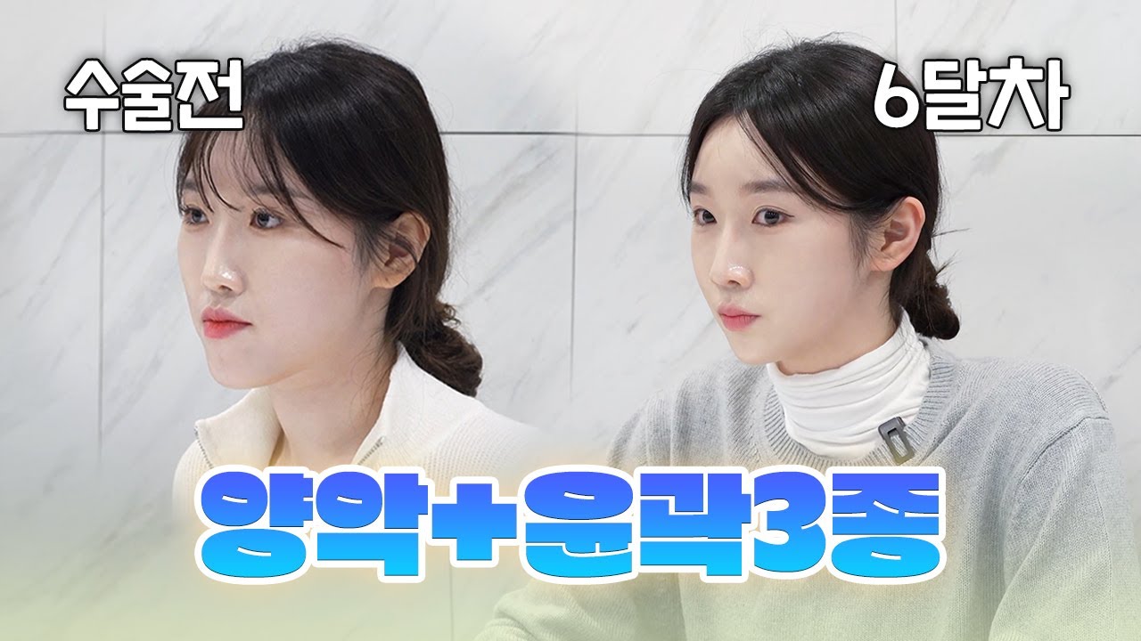 양악수술 후 얼굴 조막만해진 근황,,💞 양악+윤곽3종 6달차 리뷰