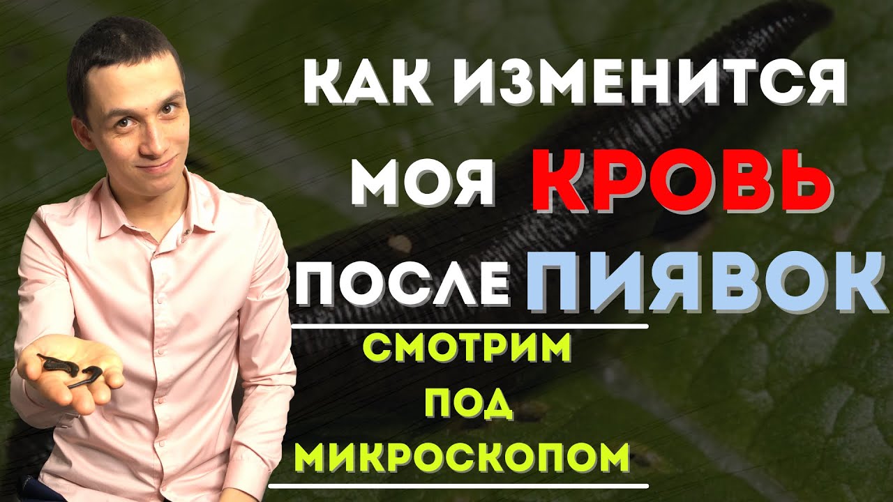 Как ставить пиявки в домашних условиях!? Польза &laquo;Гирудотерапии&raquo;