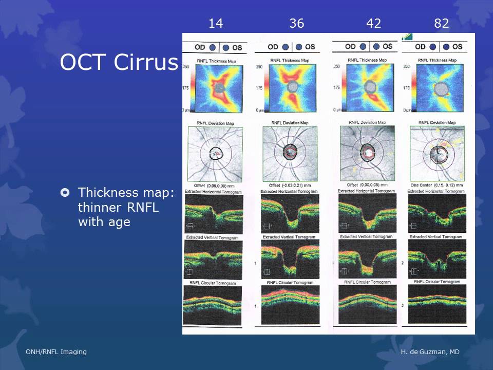 ONH and RNFL Imaging by Dr. Hannah de Guzman