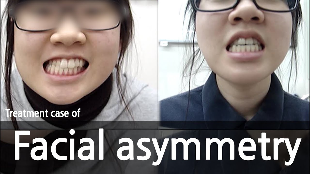 Treatment case of Facial asymmetry 안면비대칭 치료사례