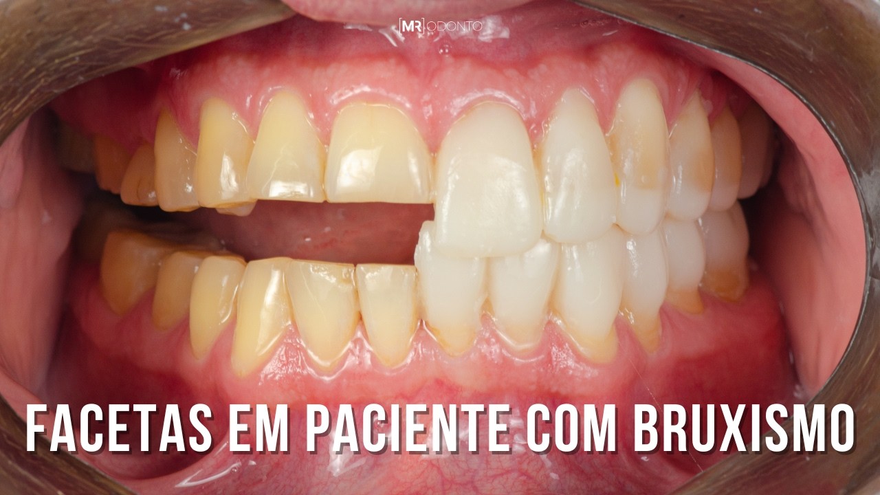 FACETAS DE RESINA EM PACIENTE COM BRUXISMO