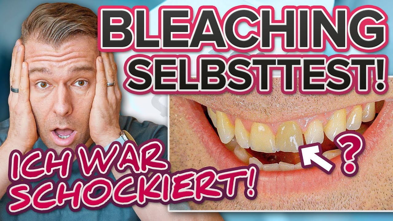 Zahnaufhellung: Zahnarzt bekommt selbst die Zähne gebleacht!