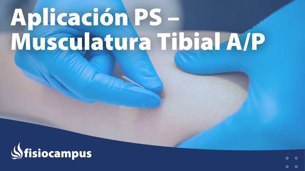 punción seca del tibial anterior y posteriorr