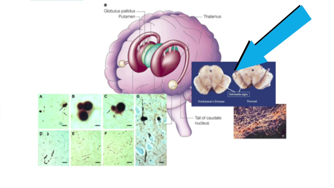 Curing Parkinson's by transplanting cells