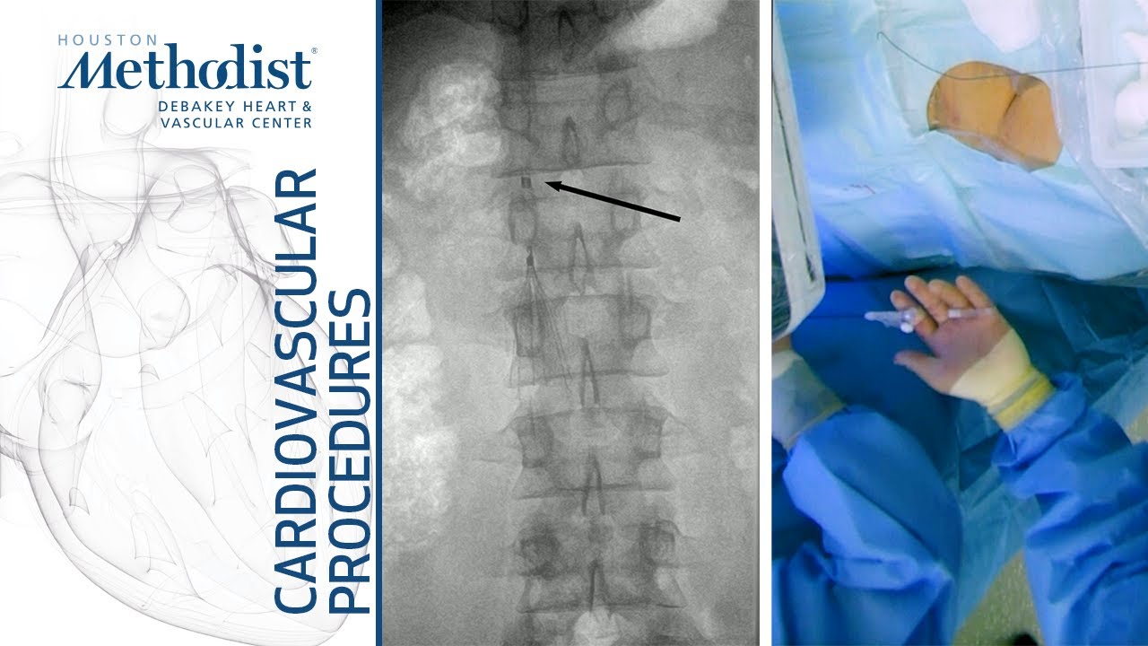 Standard IVC Filter Retrieval (Alan B  Lumsden, MD, Peter Osztrogonacz, MD)