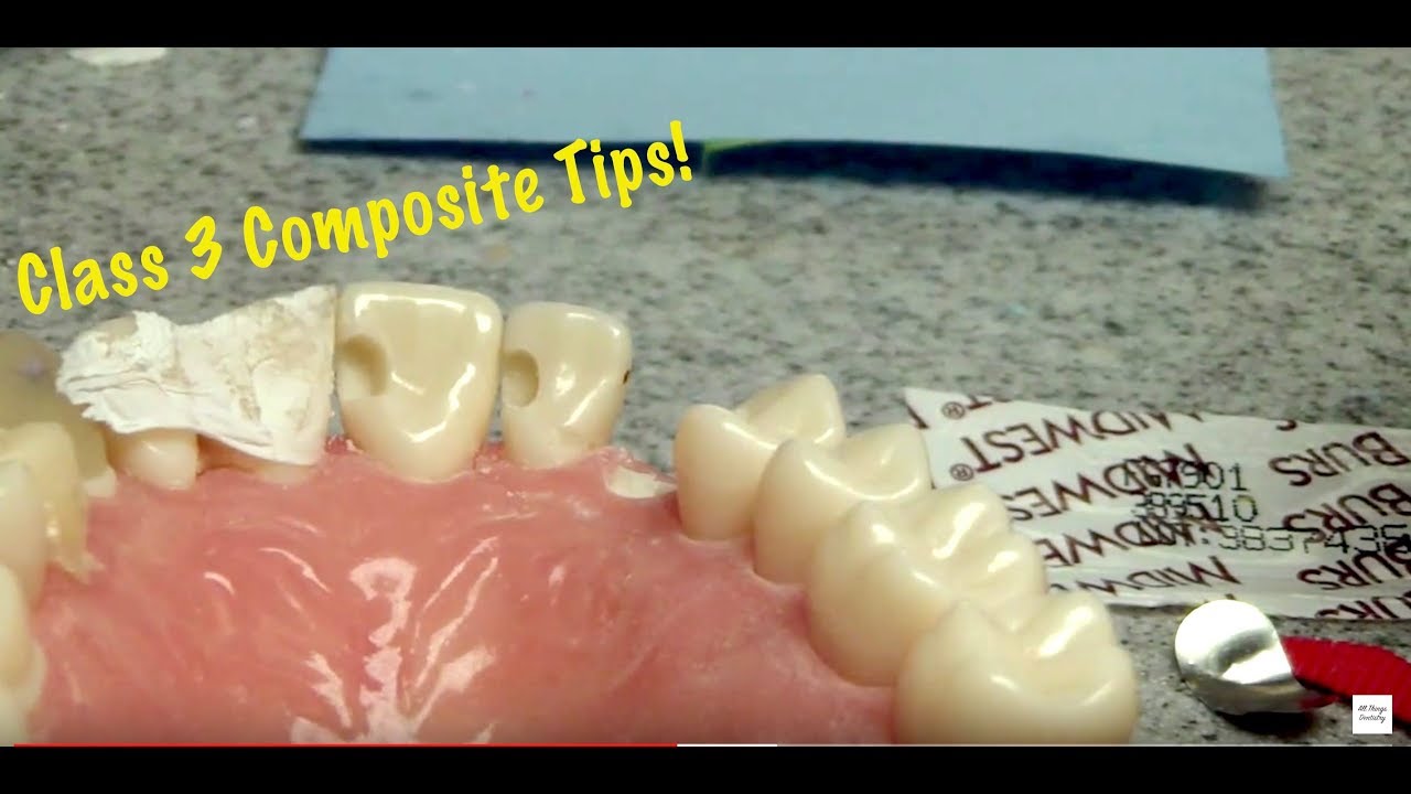 Class 3 Composite Tips