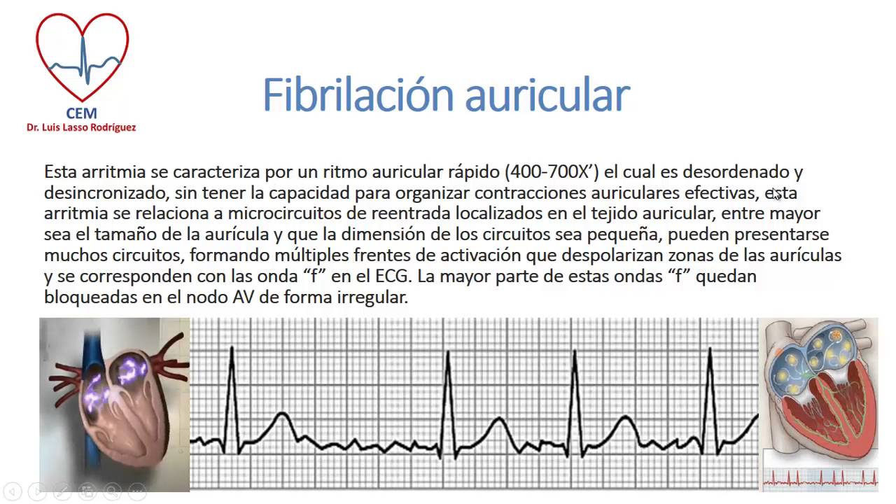 Aspectos electrocardiográficos de las arritmias supraventriculares