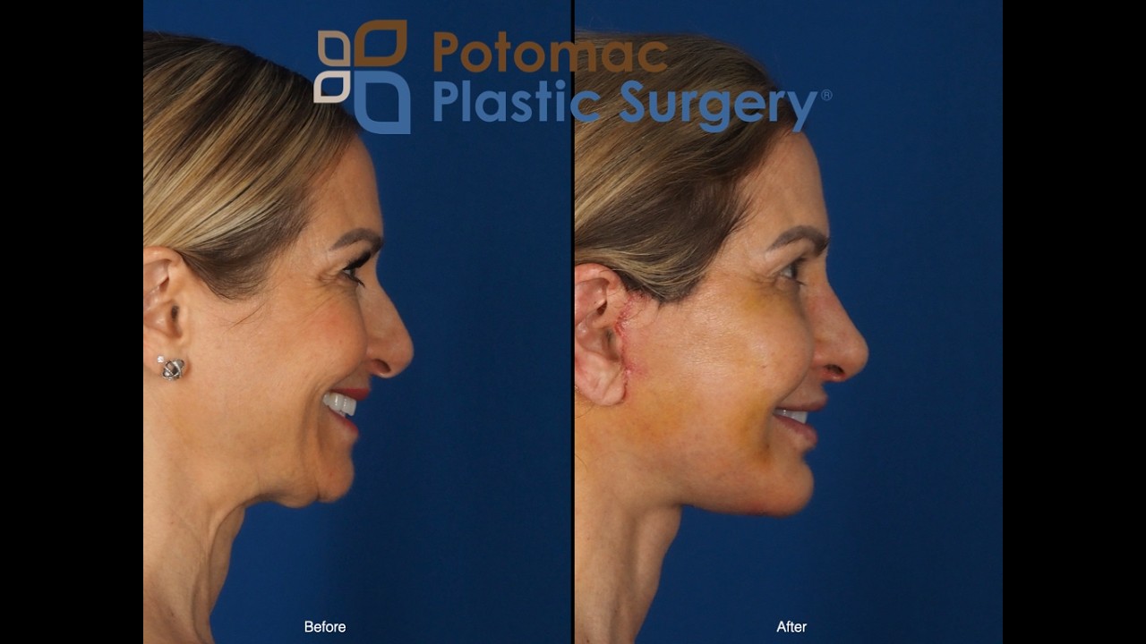 Testimonial - 1 week after deep plane facelift and rhinoplasty in 50 year-old woman