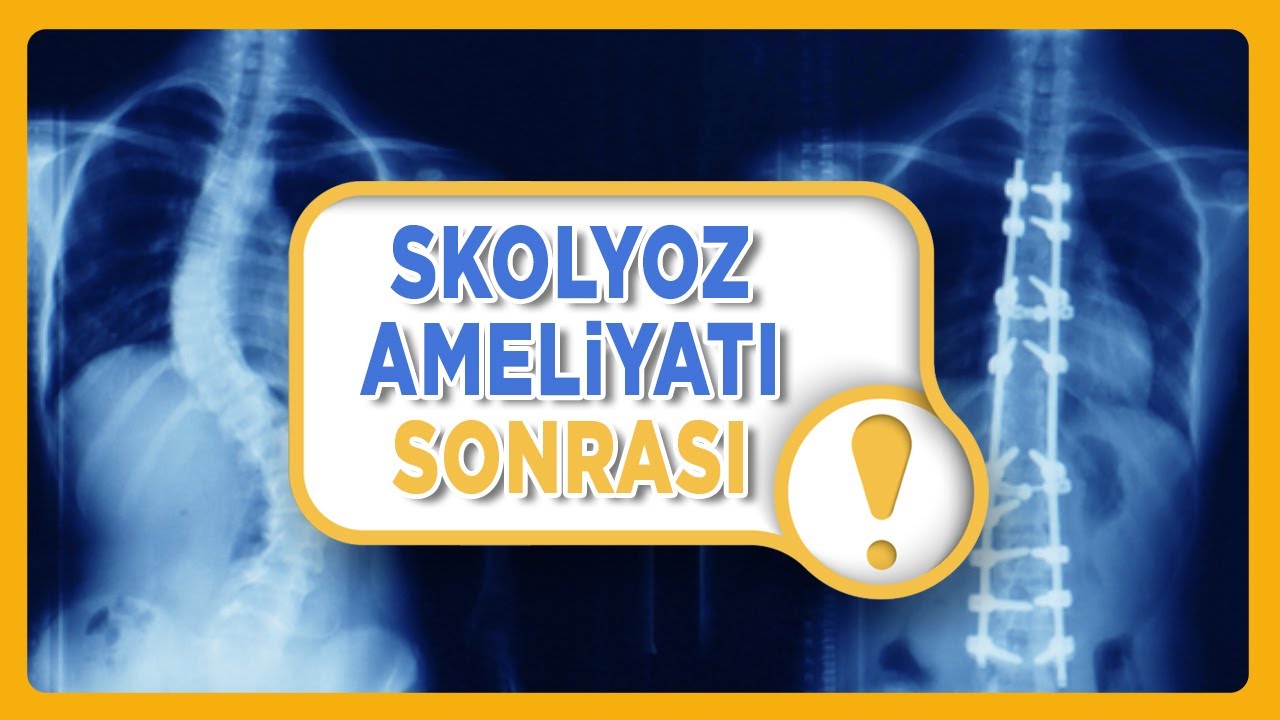 Skolyoz Ameliyatı Sonrası Dikkat Edilmesi Gerekenler ve İyileşme Süreci