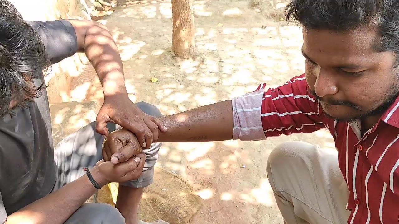 My hand bone setting by my friend|Natural Bone setting|accident|best method to set bone