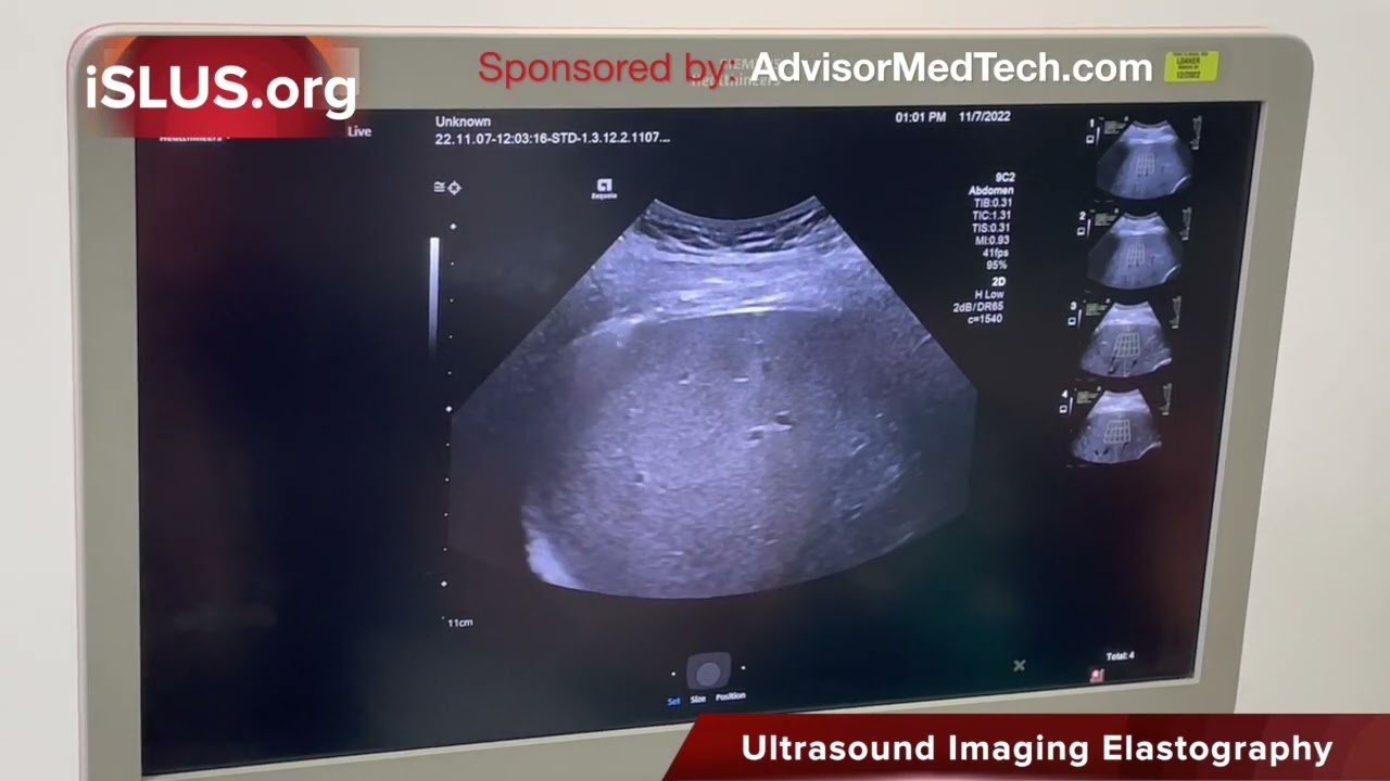 Siemens Liver Ultrasound Elastography AASLD Technology Spotlight