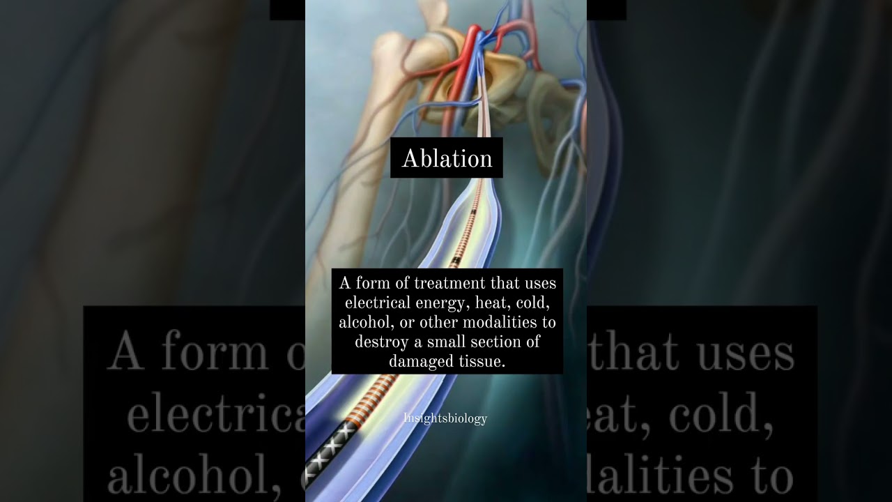 Ablation- Medical dictionary/ Insightsofbiology/Scientistwhoslays