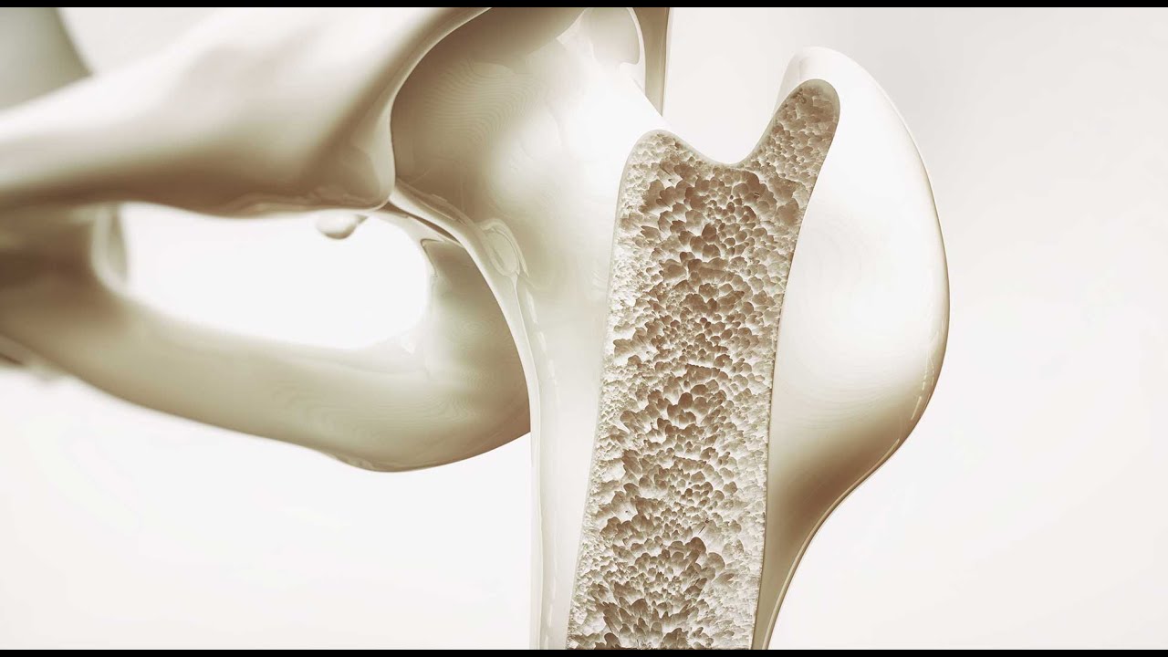 Osteoporose &ndash; die versteckte Pandemie?