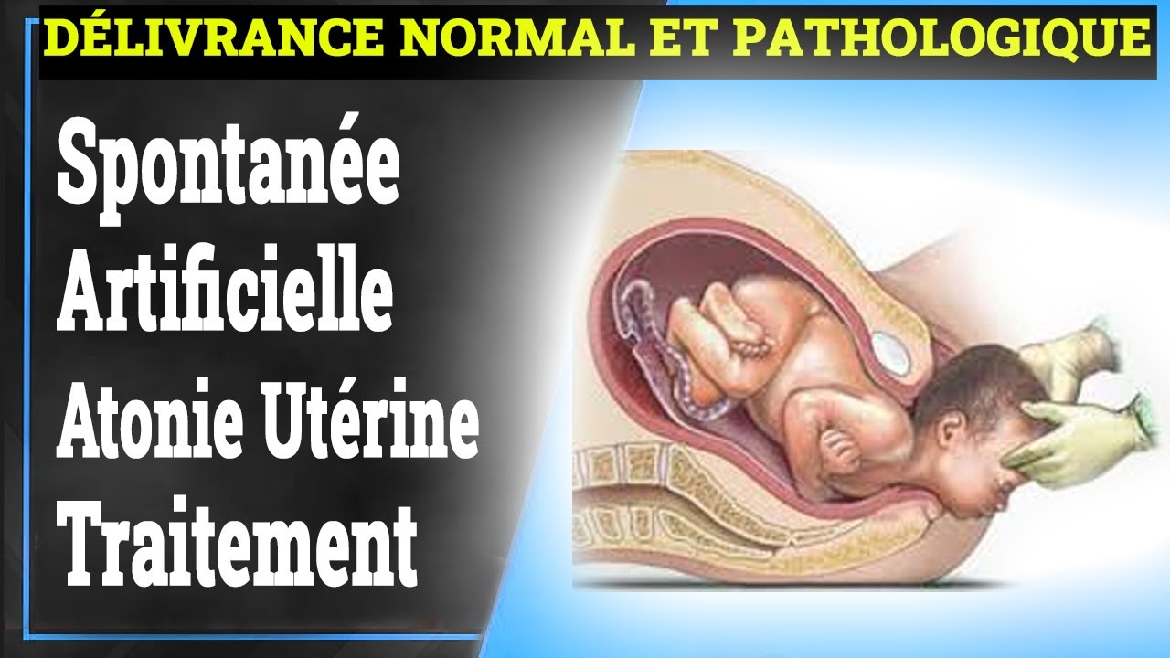 Délivrance Normal et Pathologique | Gynécologie