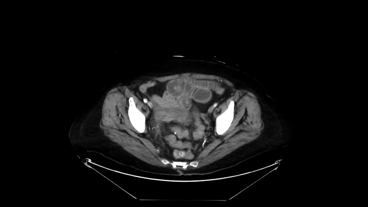 Gallstone ileus
