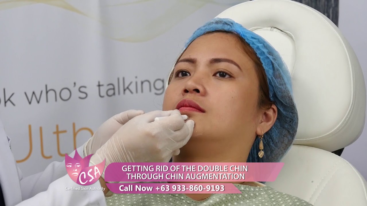 GETTING RID OF THE DOUBLE CHIN  THROUGH CHIN AUGMENTATION