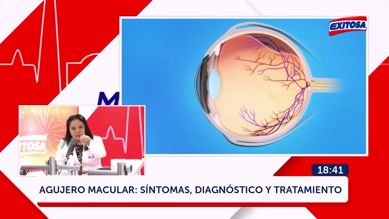 Agujero Macular: Síntomas, diagnóstico, tratamiento