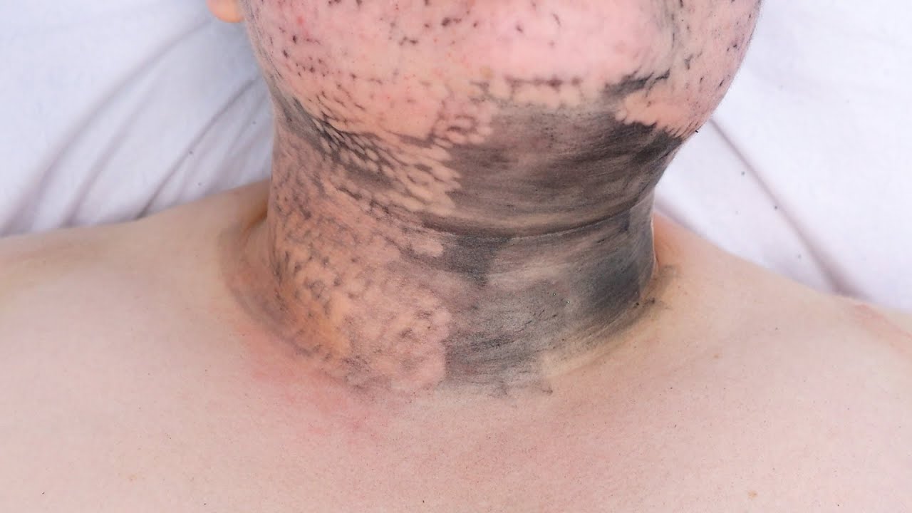 Zabieg BLACK DOLL!  Laserowy peeling węglowy - Ogólnopolska Akademia Kosmetologii